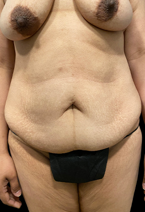 Abdominoplasty Before & After Gallery - Patient 77368594 - Image 1