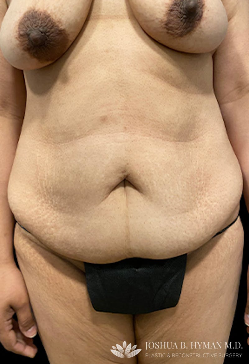 Abdominoplasty Before & After Gallery - Patient 77368594 - Image 1