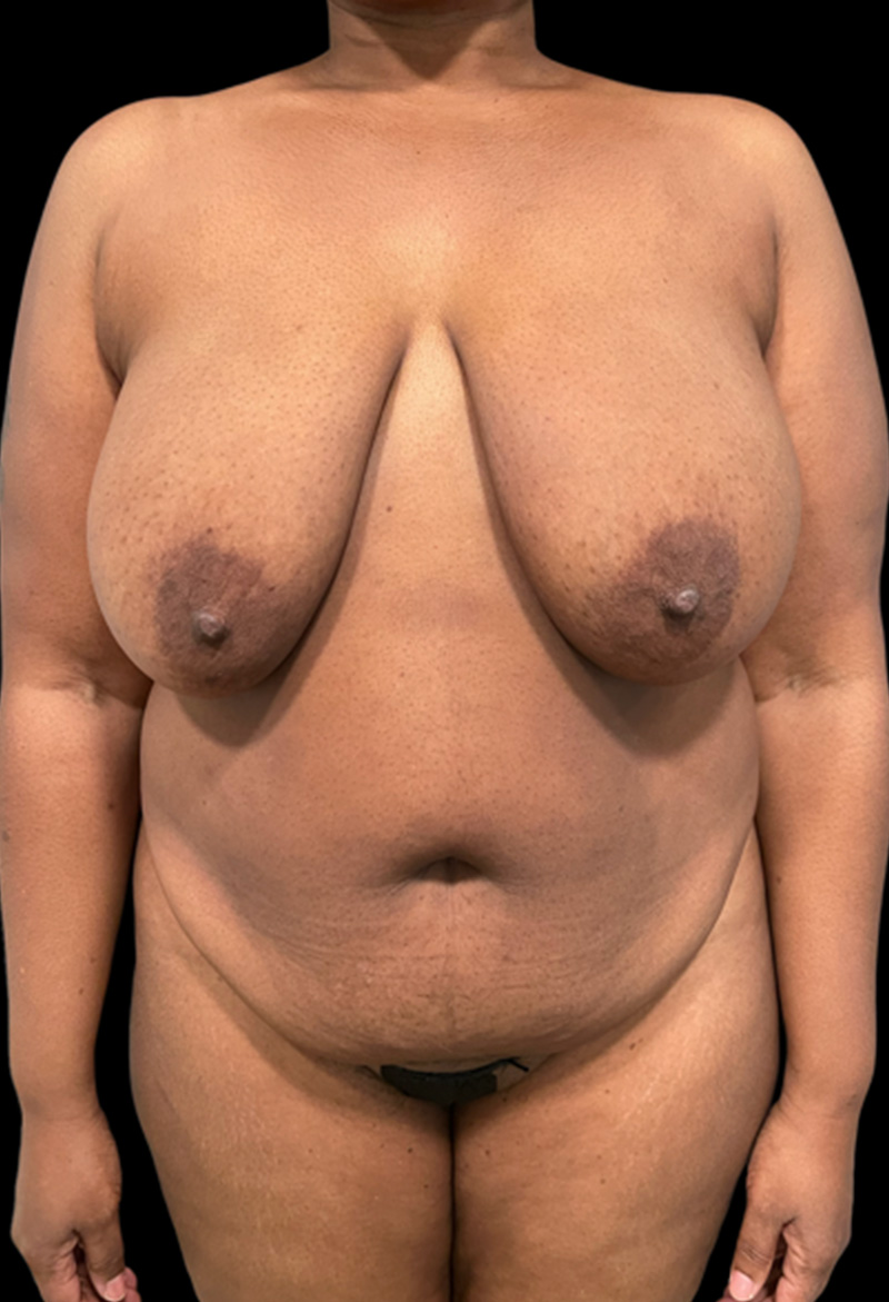 Mommy Makeover Before & After Gallery - Patient 102684009 - Image 1