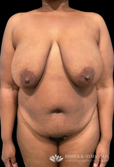Mommy Makeover Before & After Gallery - Patient 102684009 - Image 1