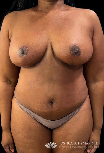 Mommy Makeover Before & After Gallery - Patient 102684009 - Image 2