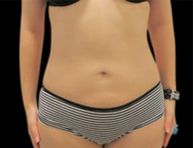 Liposuction Before & After Gallery - Patient 58232375 - Image 2