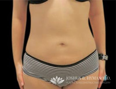 Liposuction Before & After Gallery - Patient 58232375 - Image 2