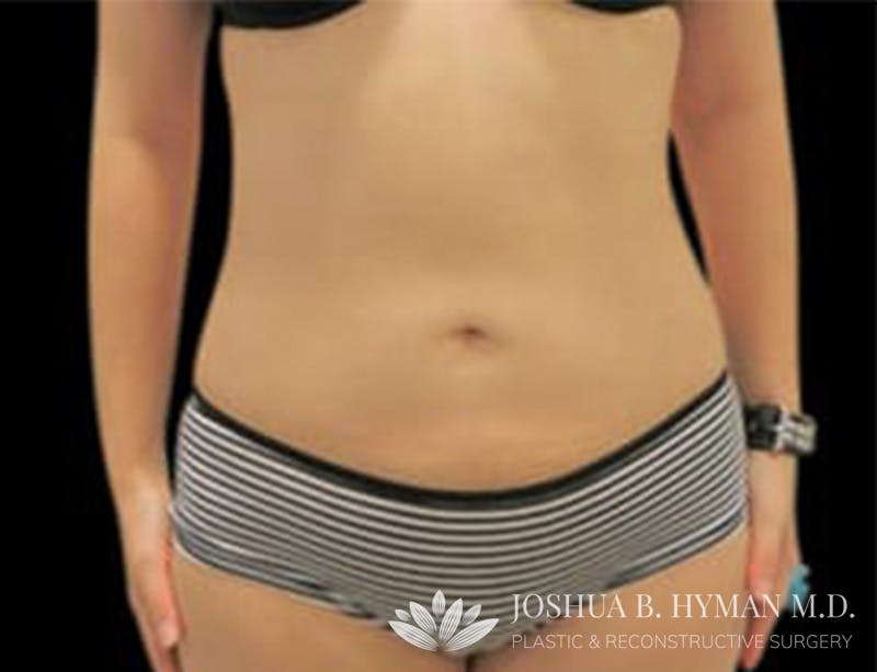 Liposuction Before & After Gallery - Patient 58232375 - Image 2