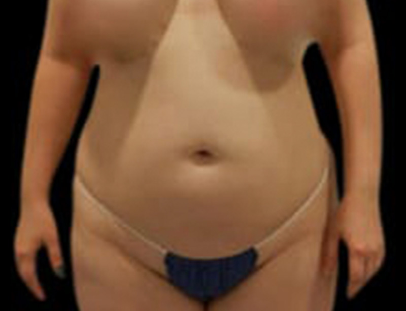 Liposuction Before & After Gallery - Patient 58232375 - Image 1