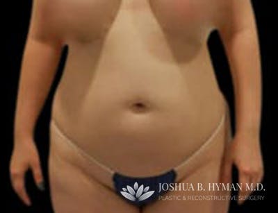 Liposuction Before & After Gallery - Patient 58232375 - Image 1