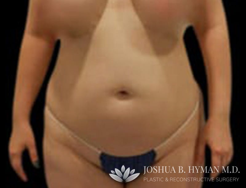 Liposuction Before & After Gallery - Patient 58232375 - Image 1