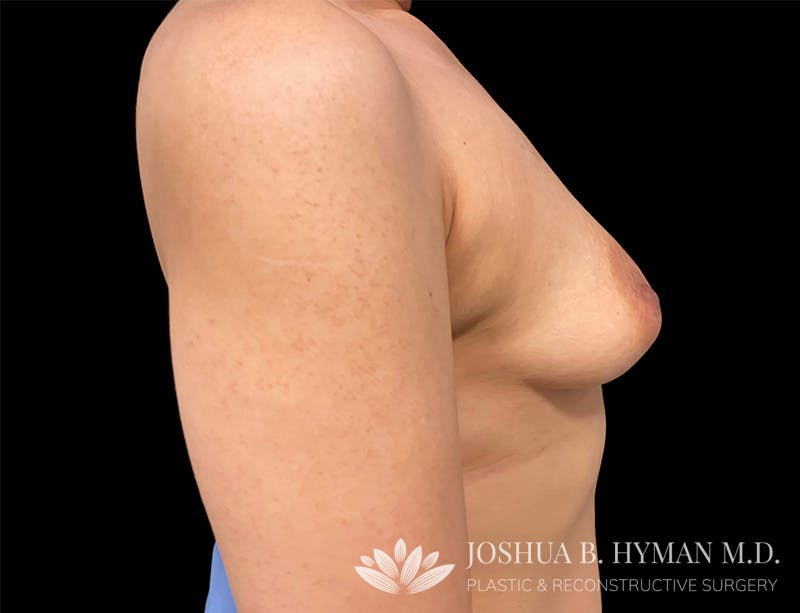 Breast Augmentation Before & After Gallery - Patient 111838034 - Image 3