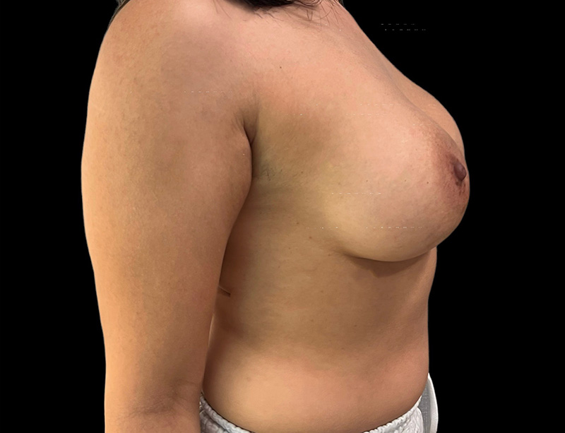 Breast Augmentation Before & After Gallery - Patient 111838034 - Image 4