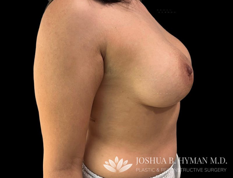 Breast Augmentation Before & After Gallery - Patient 111838034 - Image 4