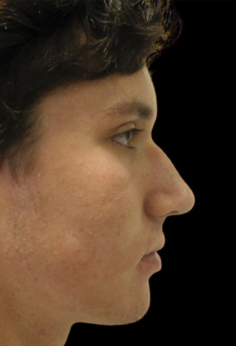 Male Rhinoplasty Before & After Gallery - Patient 133266344 - Image 1