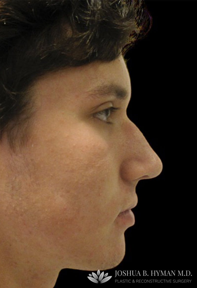 Male Rhinoplasty Before & After Gallery - Patient 133266344 - Image 1