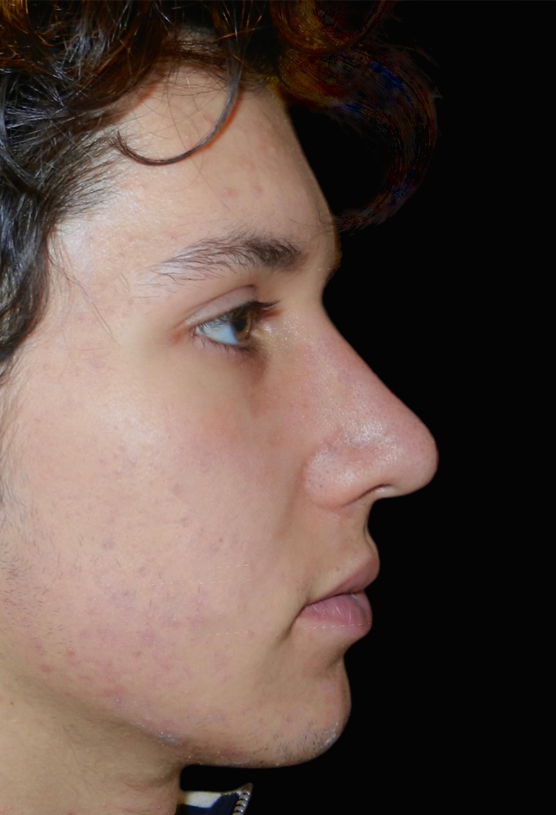 Rhinoplasty Before & After Gallery - Patient 133266342 - Image 2