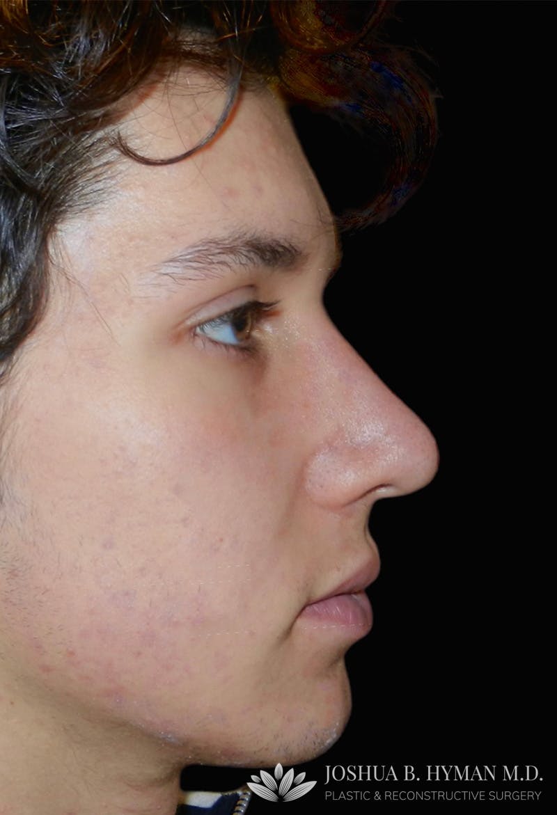 Rhinoplasty Before & After Gallery - Patient 133266342 - Image 2