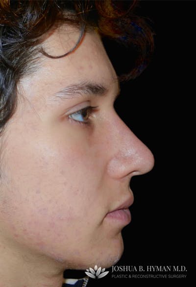 Rhinoplasty Before & After Gallery - Patient 133266344 - Image 2