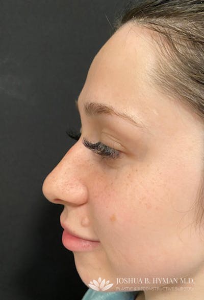 Rhinoplasty Before & After Gallery - Patient 177655072 - Image 1
