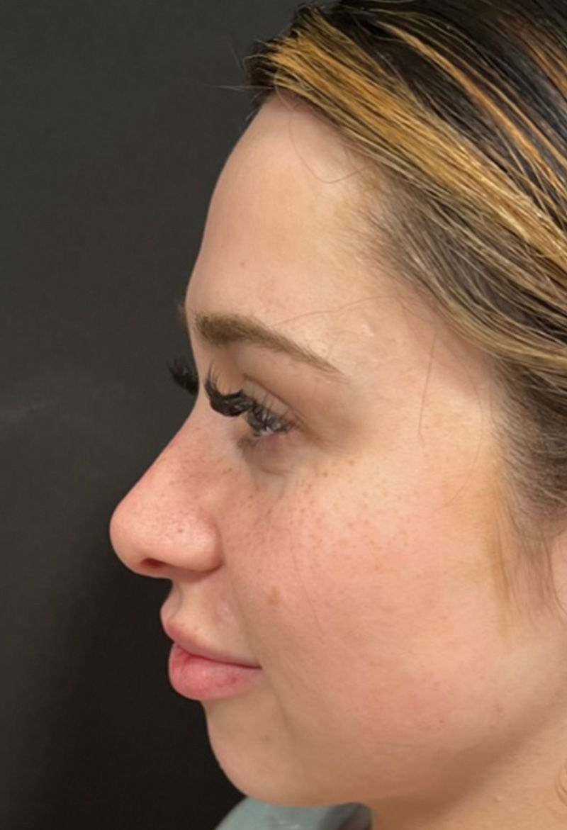 Rhinoplasty Before & After Gallery - Patient 177655072 - Image 2