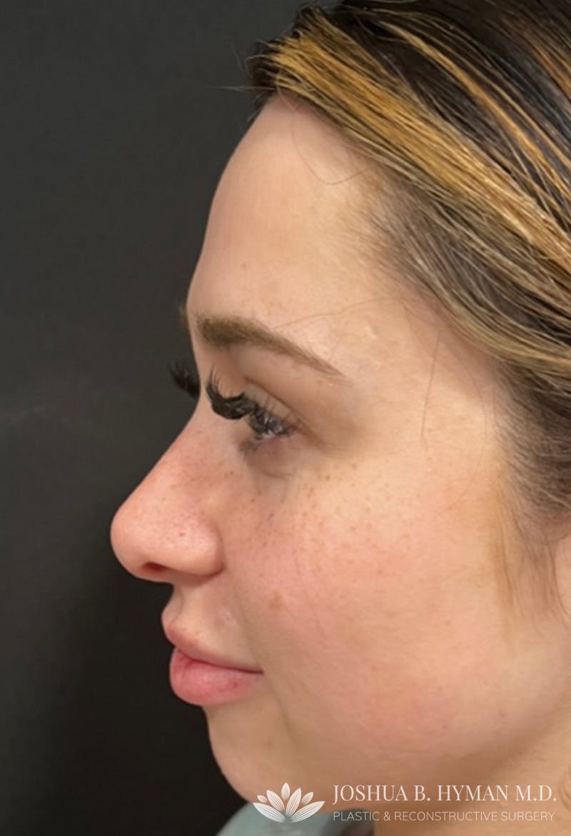 Rhinoplasty Before & After Gallery - Patient 177655072 - Image 2