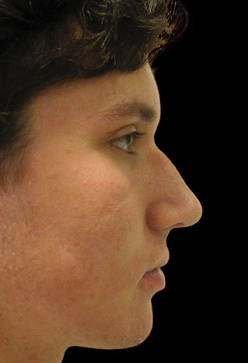 Rhinoplasty Before & After Gallery - Patient 133266342 - Image 1
