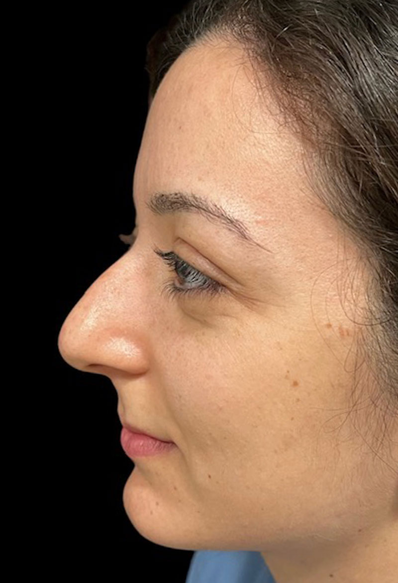 Rhinoplasty Before & After Gallery - Patient 179730868 - Image 1