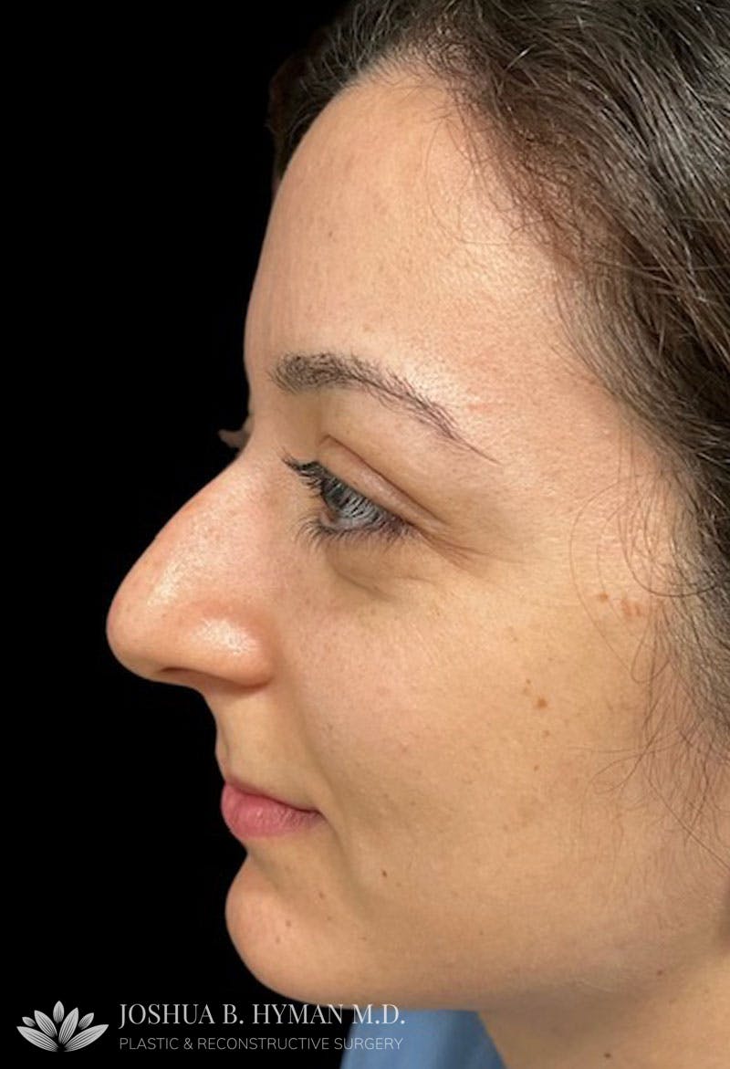 Rhinoplasty Before & After Gallery - Patient 179730868 - Image 1