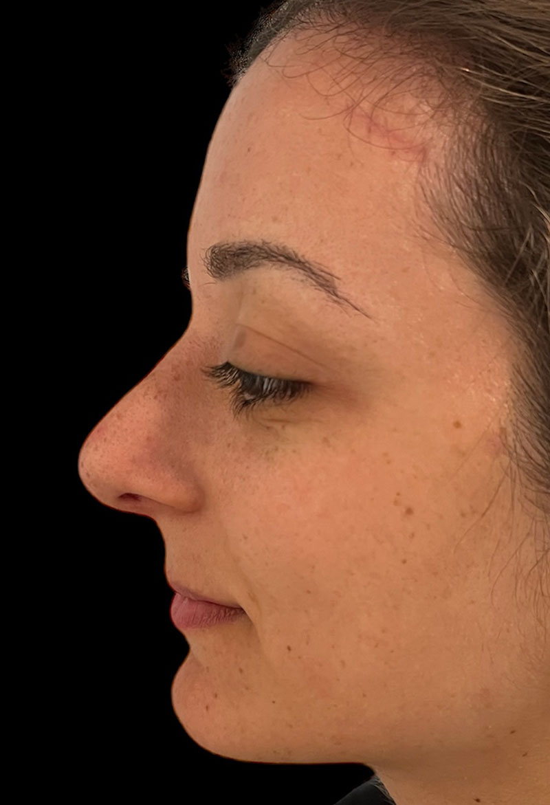 Rhinoplasty Before & After Gallery - Patient 179730868 - Image 2