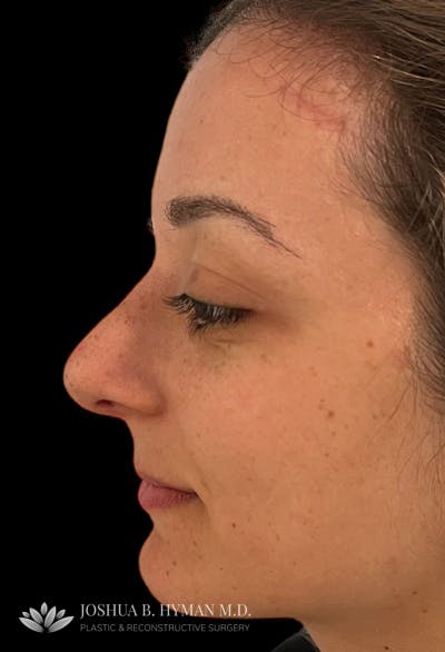 Rhinoplasty Before & After Gallery - Patient 179730868 - Image 2