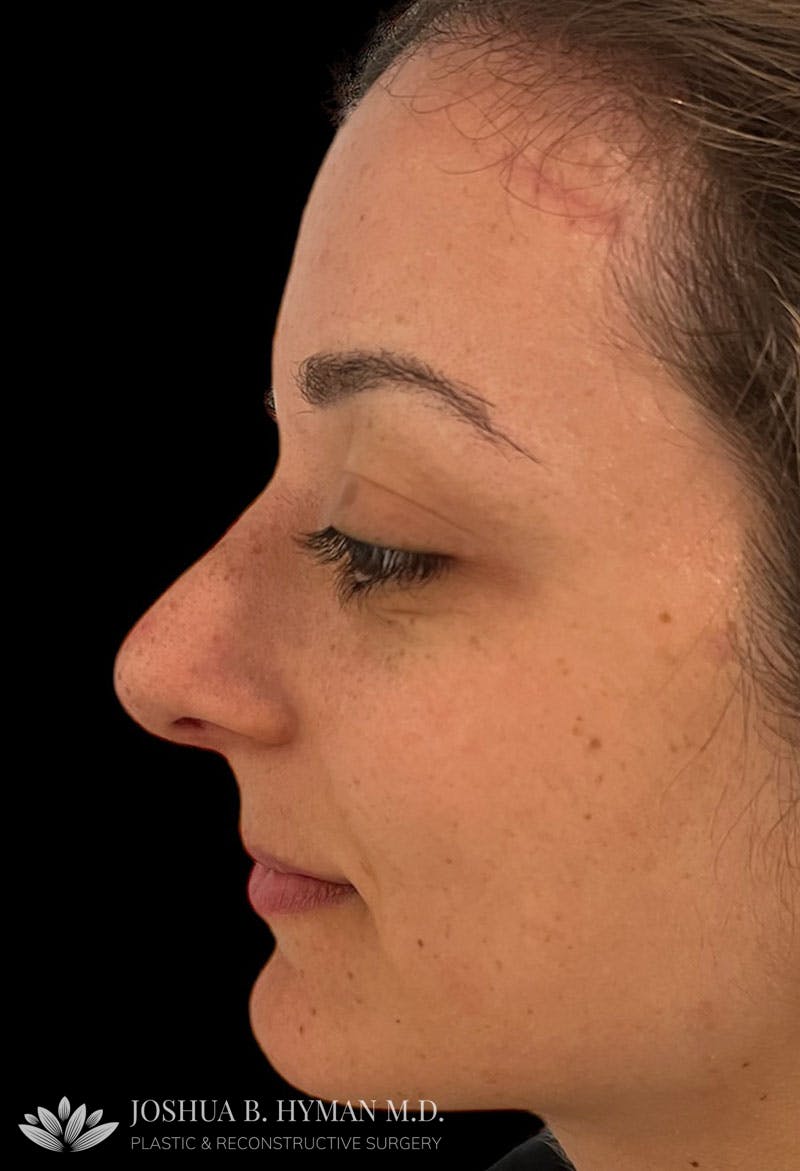 Rhinoplasty Before & After Gallery - Patient 179730868 - Image 2