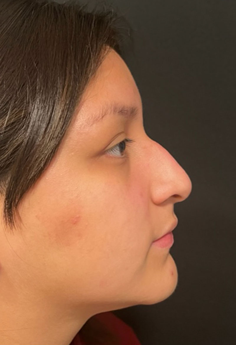 Rhinoplasty Before & After Gallery - Patient 181779882 - Image 1