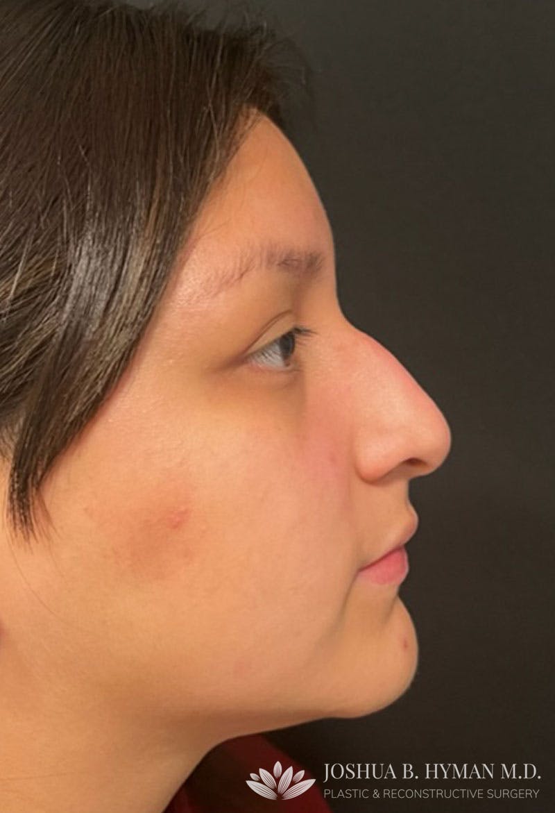 Rhinoplasty Before & After Gallery - Patient 181779882 - Image 1