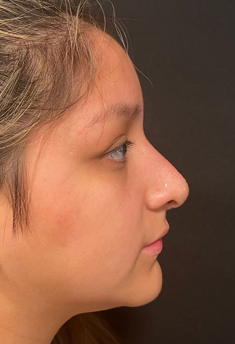 Rhinoplasty Before & After Gallery - Patient 181779882 - Image 2