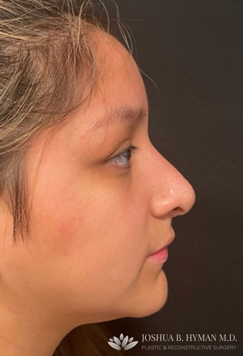 Rhinoplasty Before & After Gallery - Patient 181779882 - Image 2