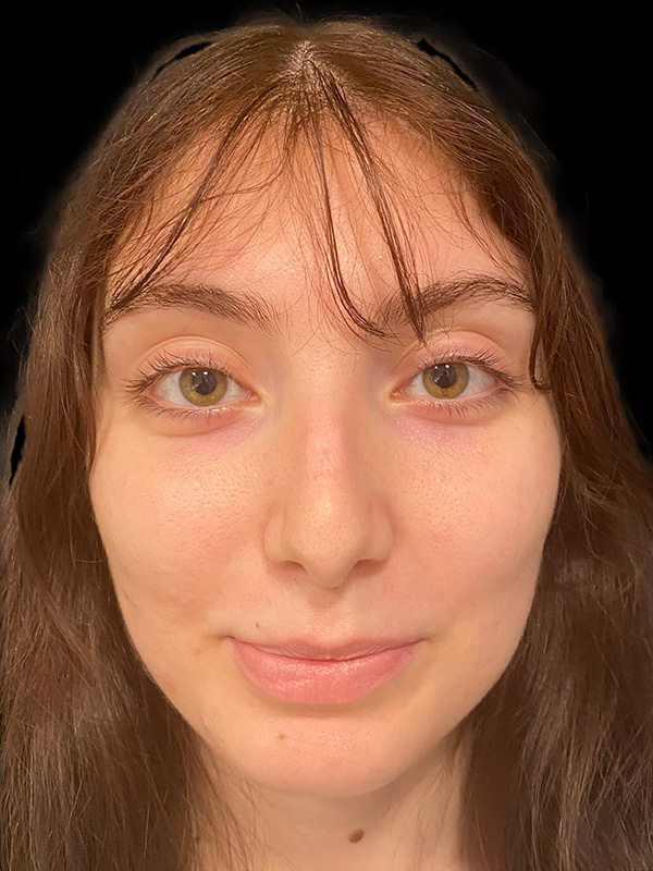 Rhinoplasty Before & After Gallery - Patient 197519425 - Image 1