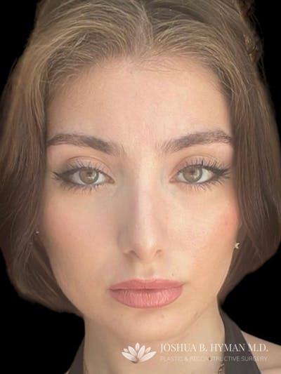 Rhinoplasty Before & After Gallery - Patient 197519425 - Image 2