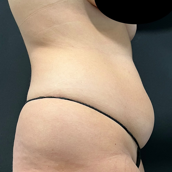 Liposuction Before & After Gallery - Patient 825895 - Image 1