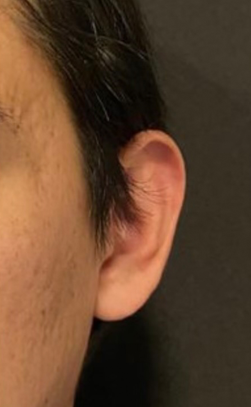 Otoplasty Before & After Gallery - Patient 908469 - Image 1