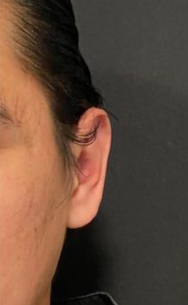 Otoplasty Before & After Gallery - Patient 908469 - Image 2