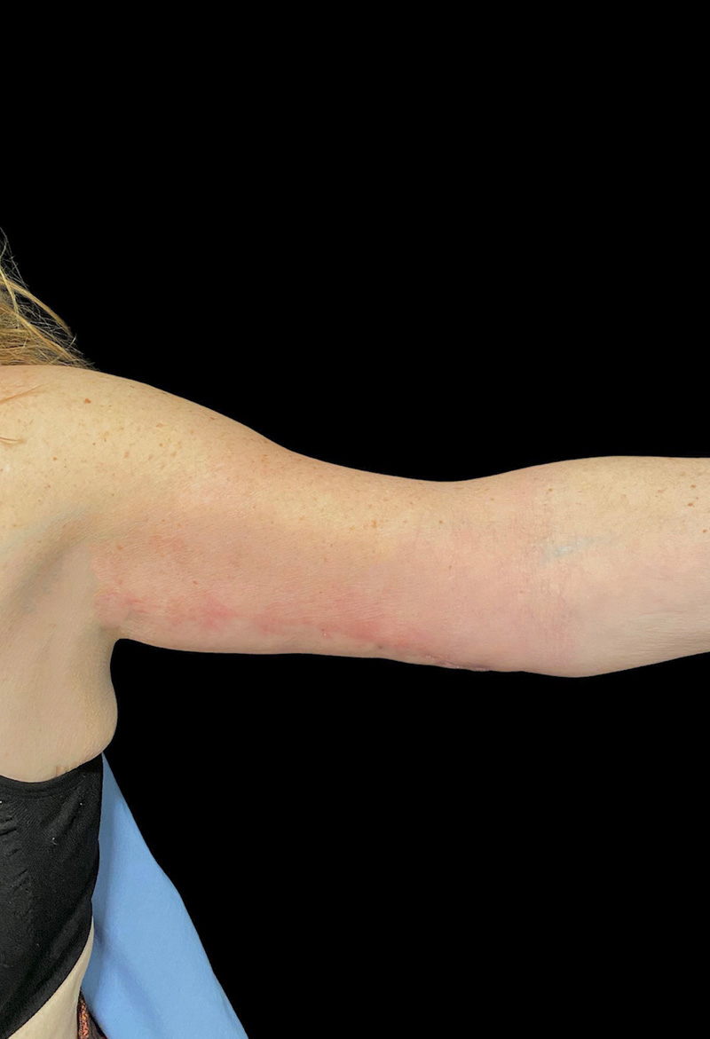 Brachioplasty Before & After Gallery - Patient 77368658 - Image 2