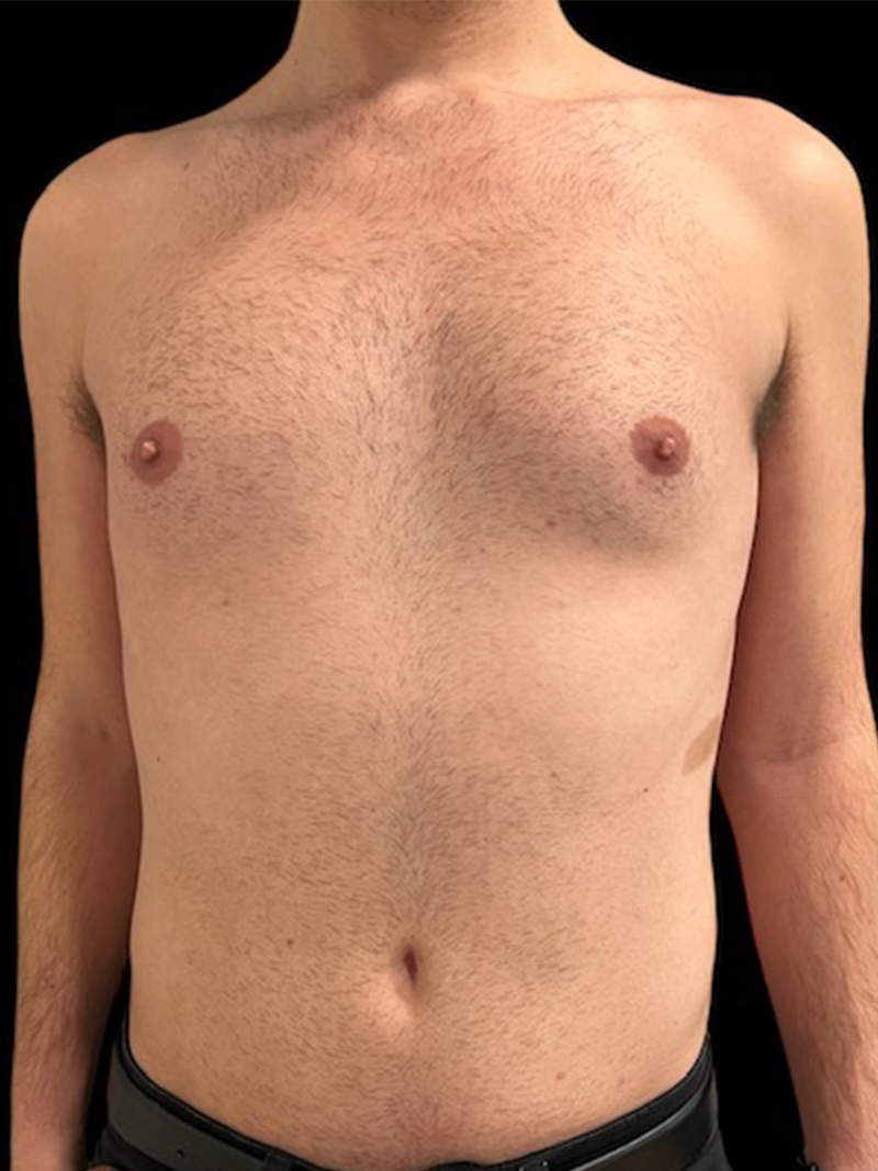 Liposuction Before & After Gallery - Patient 535834 - Image 1