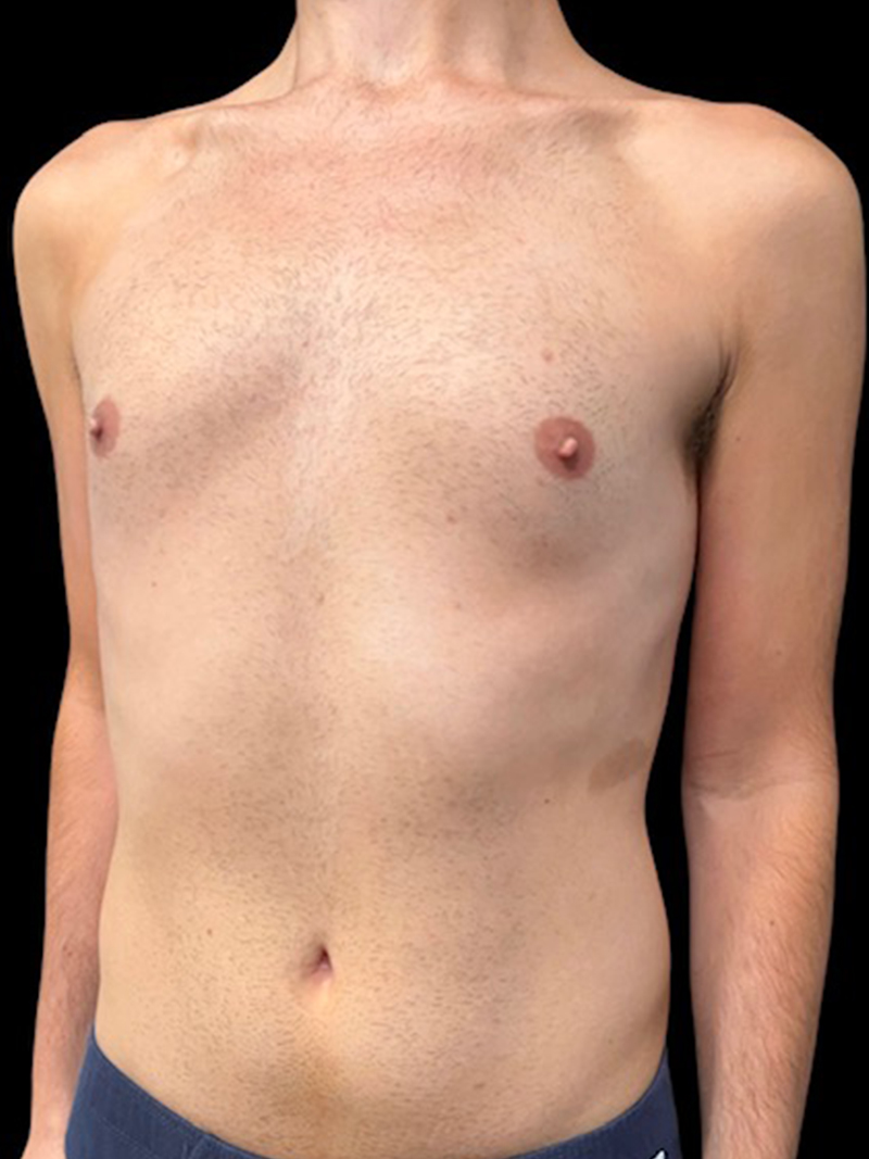 Liposuction Before & After Gallery - Patient 535834 - Image 2