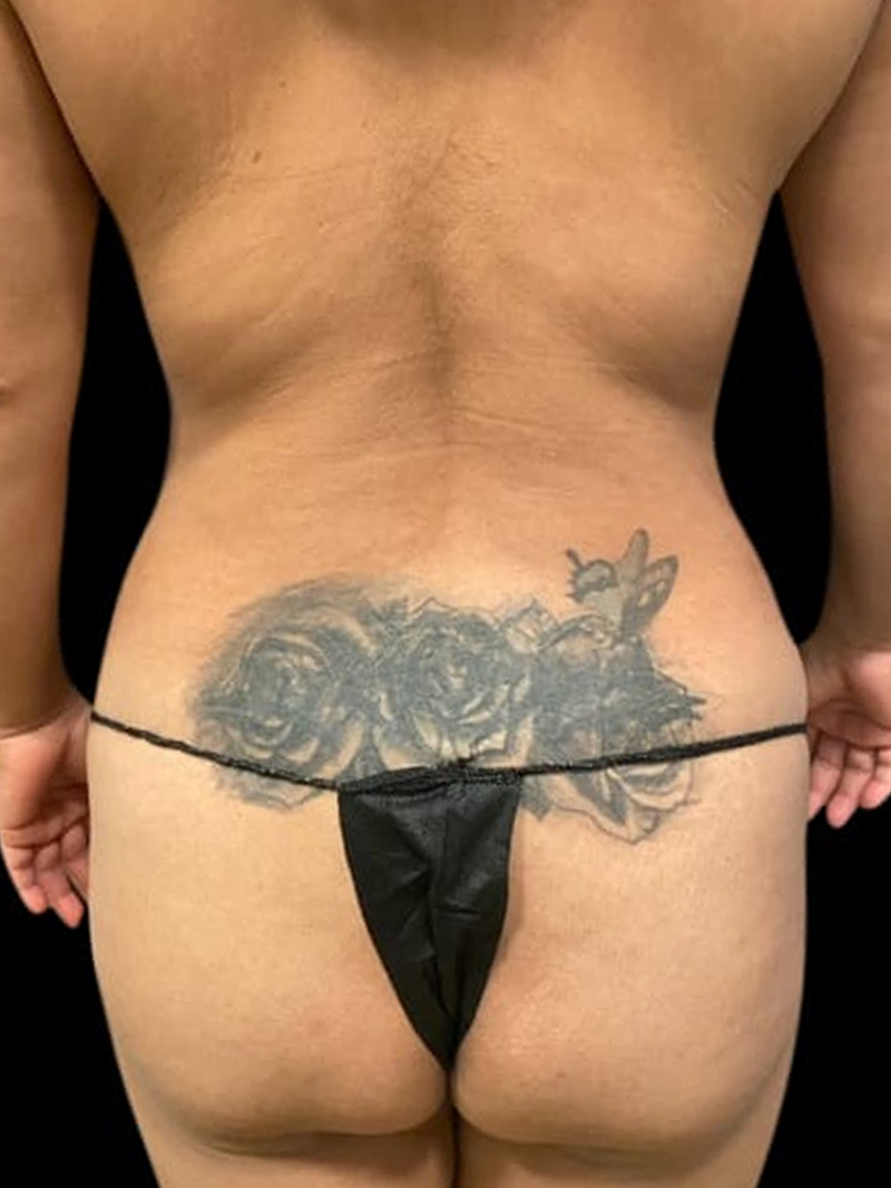 Liposuction Before & After Gallery - Patient 58232407 - Image 1