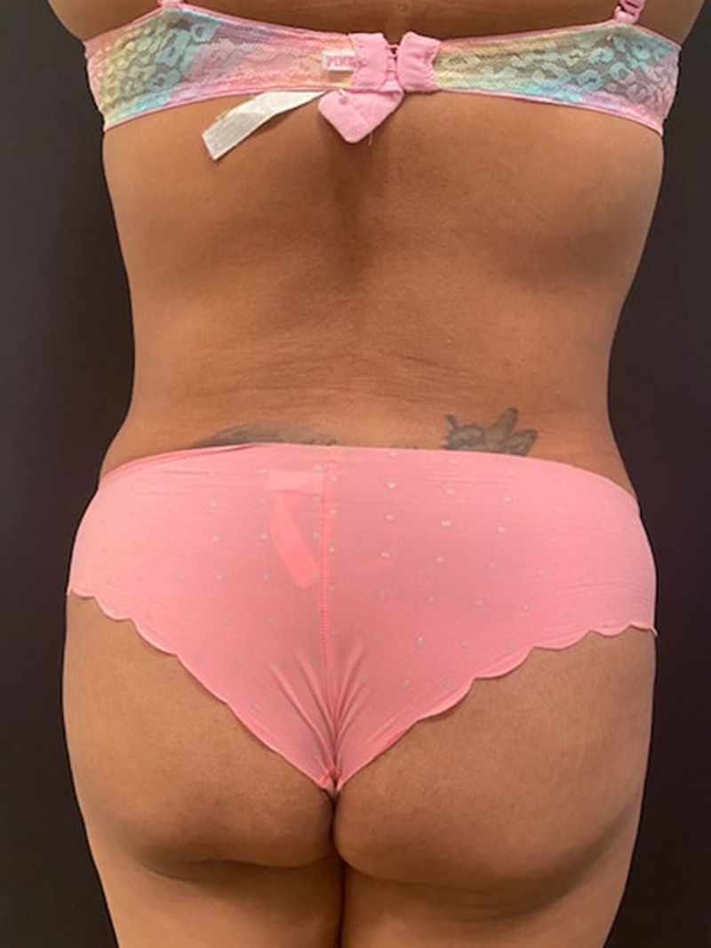 Liposuction Before & After Gallery - Patient 58232407 - Image 2