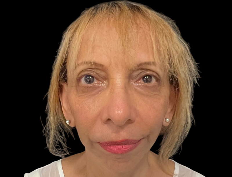 Facelift Before & After Gallery - Patient 77369273 - Image 2