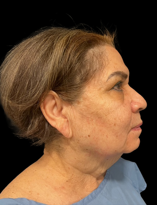 Facelift Before & After Gallery - Patient 77369274 - Image 1