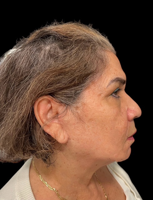 Facelift Before & After Gallery - Patient 77369274 - Image 2