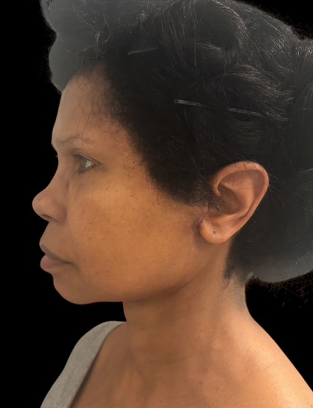 Facelift Before & After Gallery - Patient 430418 - Image 2