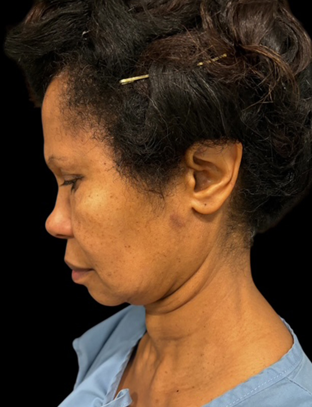 Facelift Before & After Gallery - Patient 430418 - Image 1