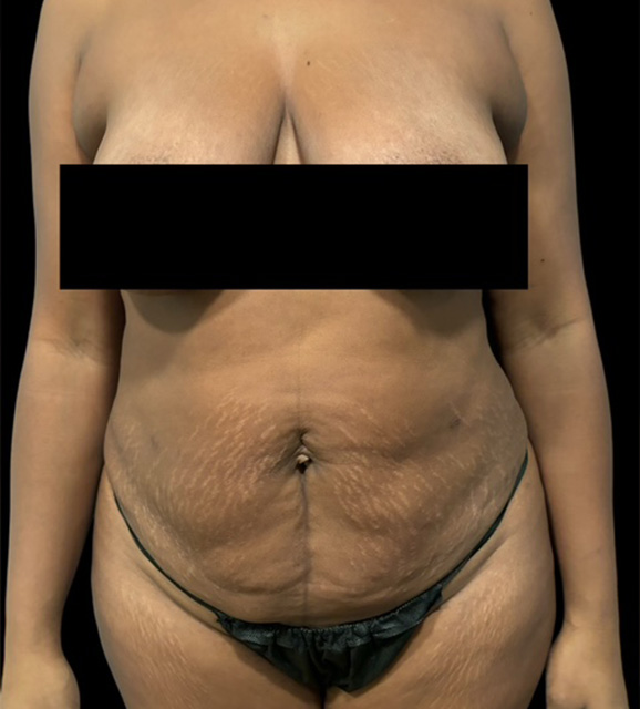 Abdominoplasty Before & After Gallery - Patient 293162 - Image 1
