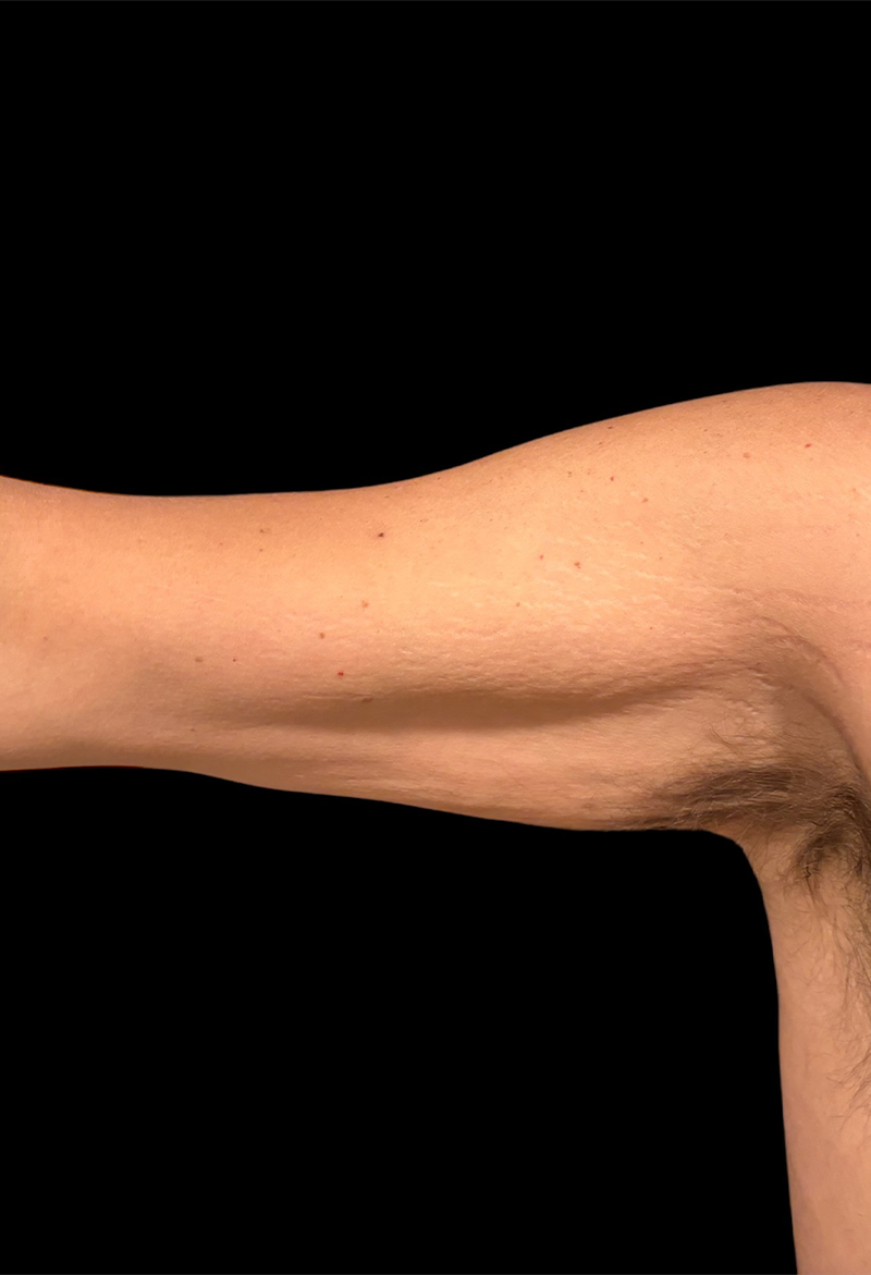 Brachioplasty Before & After Gallery - Patient 234017 - Image 1