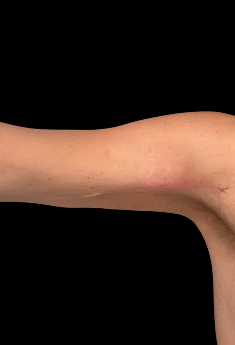 Brachioplasty Before & After Gallery - Patient 234017 - Image 2